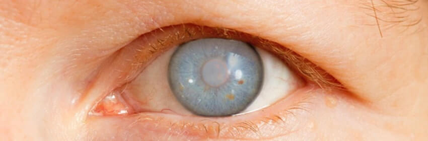 Glaucoma Management & Surgery (कांच बिंदु / काला मोतिया)